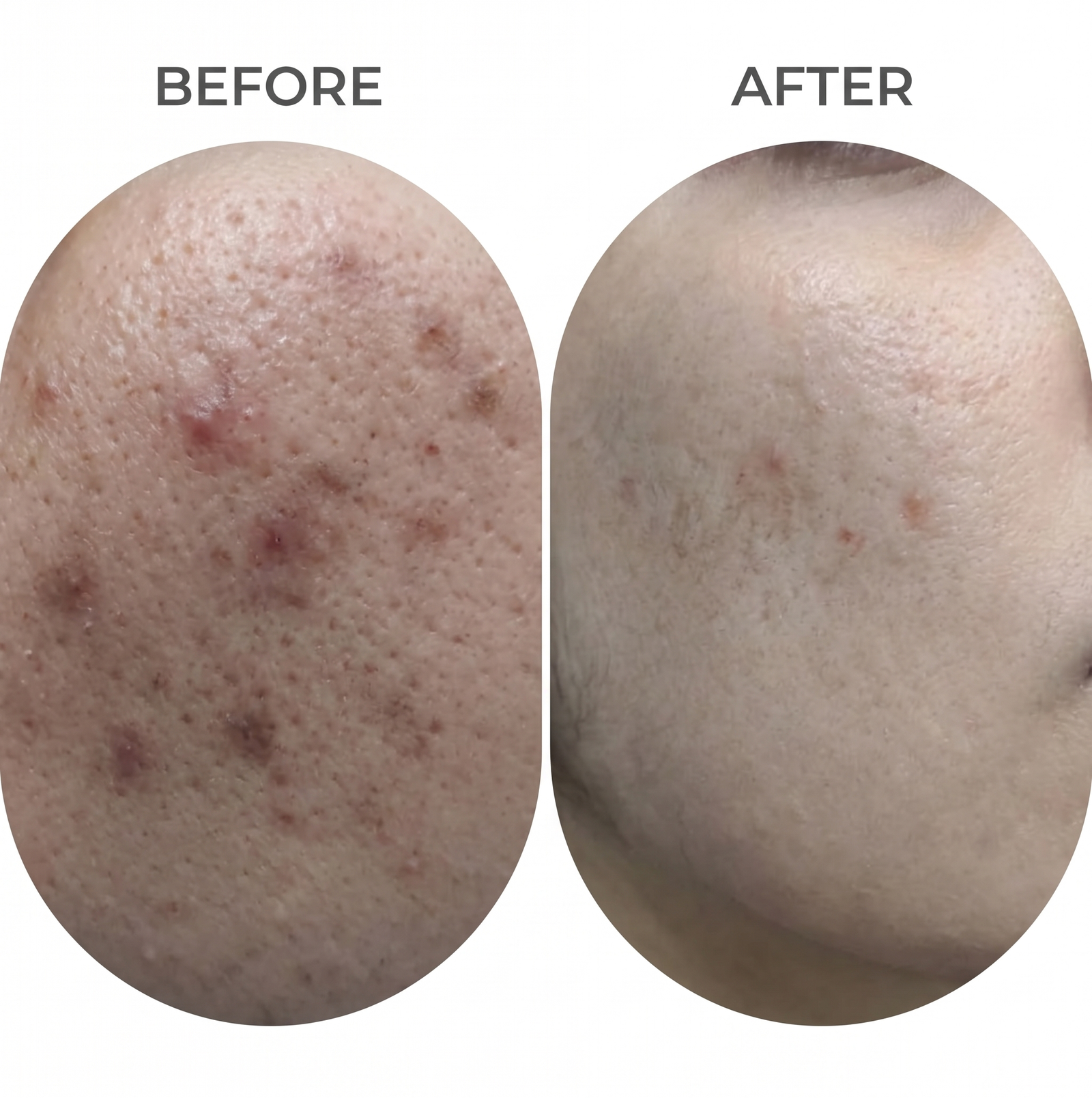 Acne Scar Treatment